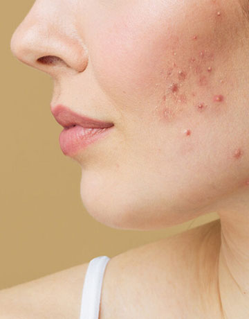 Close-up of red, inflamed bumps on a woman's cheek and jaw