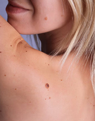 Close-up of several moles on a woman's shoulder and neck