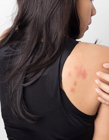 Woman looking over her shoulder at red, raised rash patches on her back