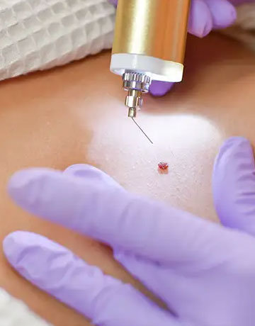 Fine-tipped device treating a small red spot on a patient's skin