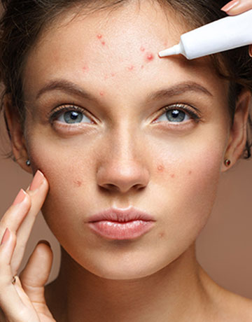 Woman with acne blemishes having cream dabbed on a spot on her forehead