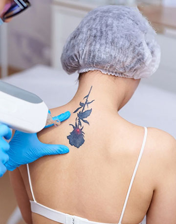 Laser handpiece treating a dark flower tattoo on a woman's upper back