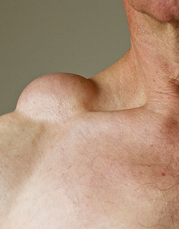 Soft, rounded lump under the skin on a man's shoulder near the neck