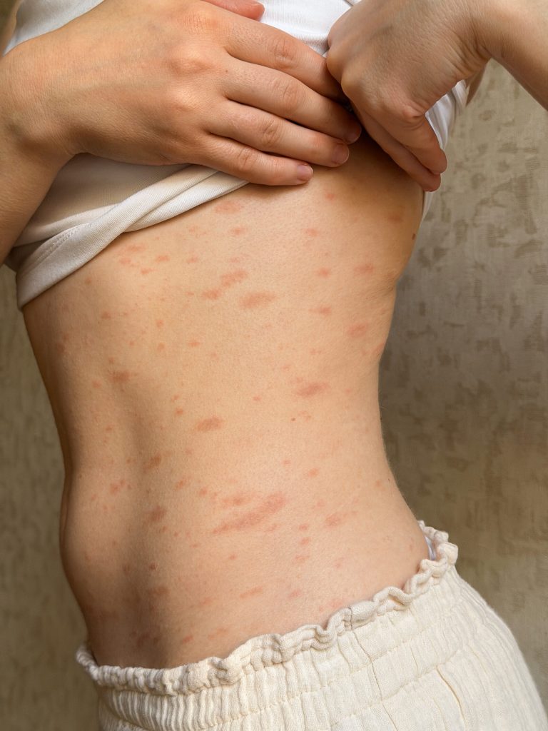 Person lifting their shirt to show scattered red patches on their side