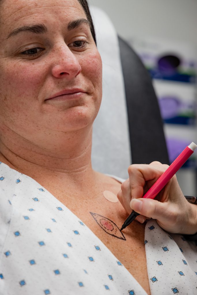 Provider marking the outline around a lesion on a woman's chest before removal