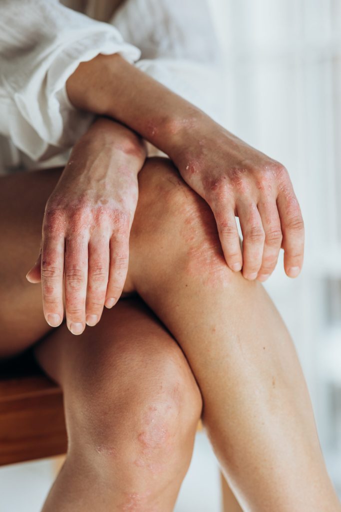 Red, scaly patches on a person's hands, wrists and knees
