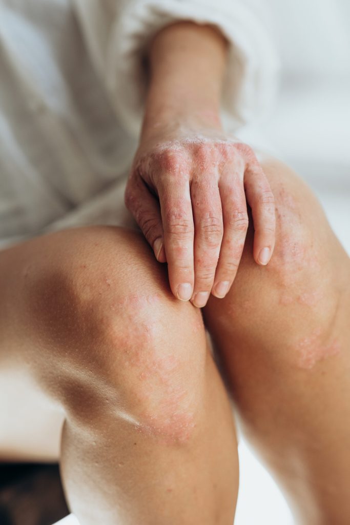 Red, scaly patches of skin on a person's knees and hand