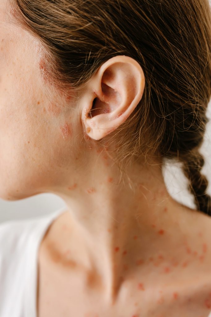 Red spots on a woman's neck and collarbone, behind her ear