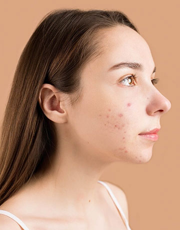 Woman in profile with acne breakouts on her cheek and jaw