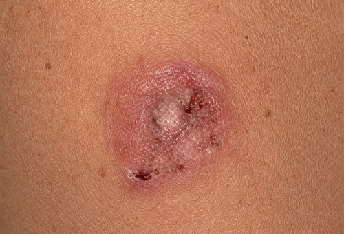 Round red, inflamed area with crusting around the treated spot