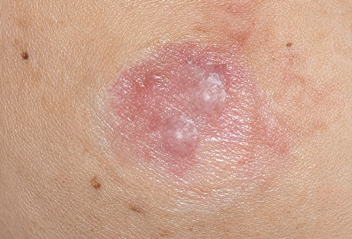 Pink, smoother patch of healing skin at the treatment site