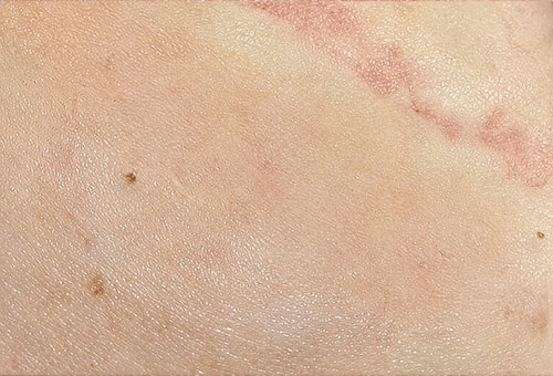 Healed skin with only a faint mark at the treatment site