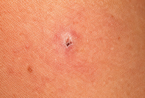Small pink skin lesion with a dark crusted center